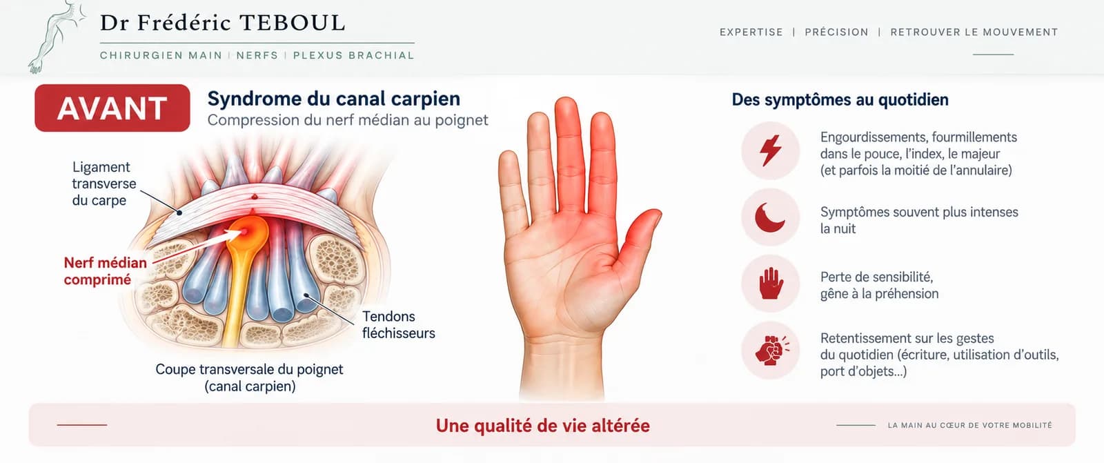 Canal carpien avant l'opération : compression du nerf médian
